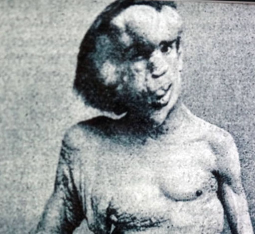 image of a man with physical deformities
